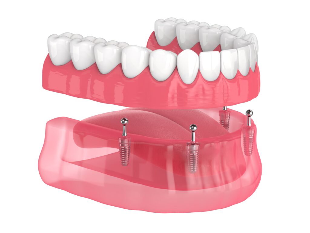 DENTURE STABILIZATION WITH MINI IMPLANTS (ONE VISIT)